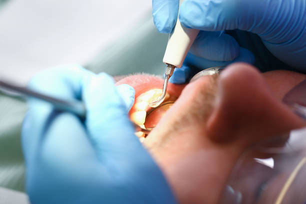 Best Dental Abscess Treatment in South St Paul, MN